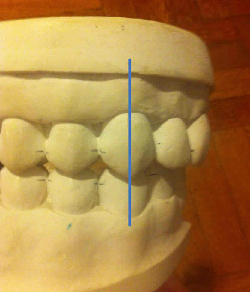 <p>the maxillary canine is mesial to the embrasure between the mandibular canine and first premolar</p><ul><li><p>the mesial slope of the max. canine is ahead of the distal slope of the man. canine</p></li><li><p>less common = about 25%</p></li></ul>