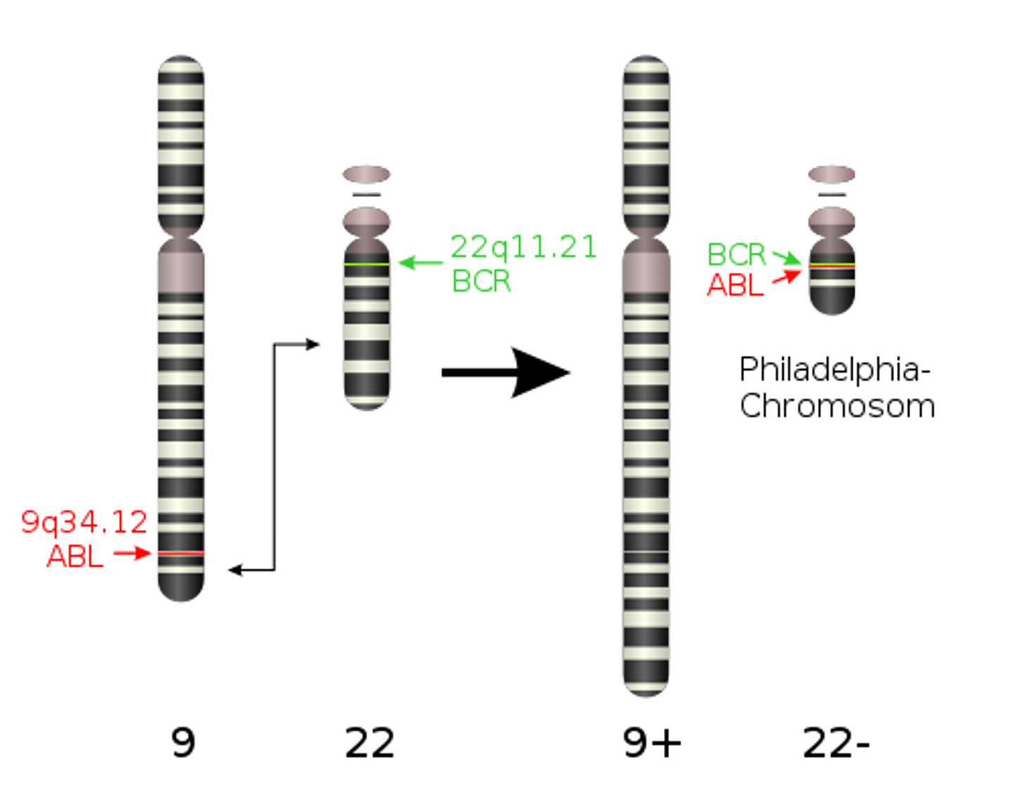 <p>-PHILADELPHIA CHROMSOME (gold standard)</p><p>-reciprocal translation between chromosome 9 and 22</p><p>-t(9;22)(q34;q11)</p><p>-this translocation relocates the oncogene ABL from 9 to 22 in the bcr region</p><p>-results in 9 being longer than usualy</p><p>-results in 22 being shorter than normal (PHILADELPHIA)</p><p>-acquired</p><p>-BCR/ABL fused gene can be see with FISH or molecular testing</p><p>-you need to see this chromosome abnormality to call it!</p><p>-Philadelphia then codes for an abnormal protein called p210 that enhances tyrosine kinase activity which very much supresses apoptosis and increases cell production!</p>