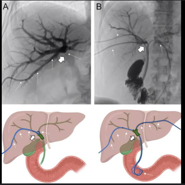 <p>a contrast medium is injected directly into the biliary radicle within the liver, and fluoroscopy is used to visualize the intrahepatic and extrahepatic bile ducts.</p>