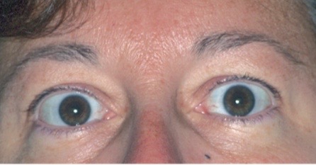 <p>eye protrusion</p><ul><li><p>associated with pathology of thyrotoxicosis</p></li></ul><p></p>