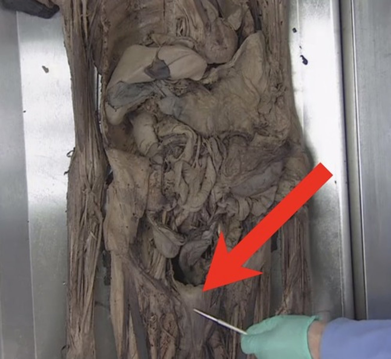 <p>(if they show you the posterior surface of the posterior rectus sheath)</p>