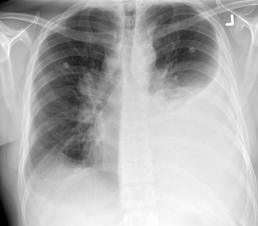 <p>this is pleural effusion, what is RA</p>
