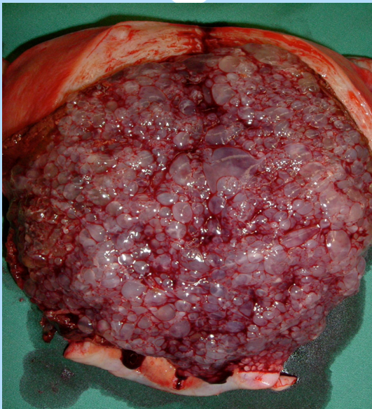 <ul><li><p>A Condition in which a proliferation of trophoblastic cells (outermost layer of embryonic cells) results in the formation of a placenta characterized by <strong>hydropic (fluid-filled)</strong> grapelike clusters.</p></li><li><p>A <strong><u>fertilized egg</u></strong> that begins developing into a pregnancy but, instead of forming a viable baby, remains as pre-cancerous cells.</p></li></ul><p></p>