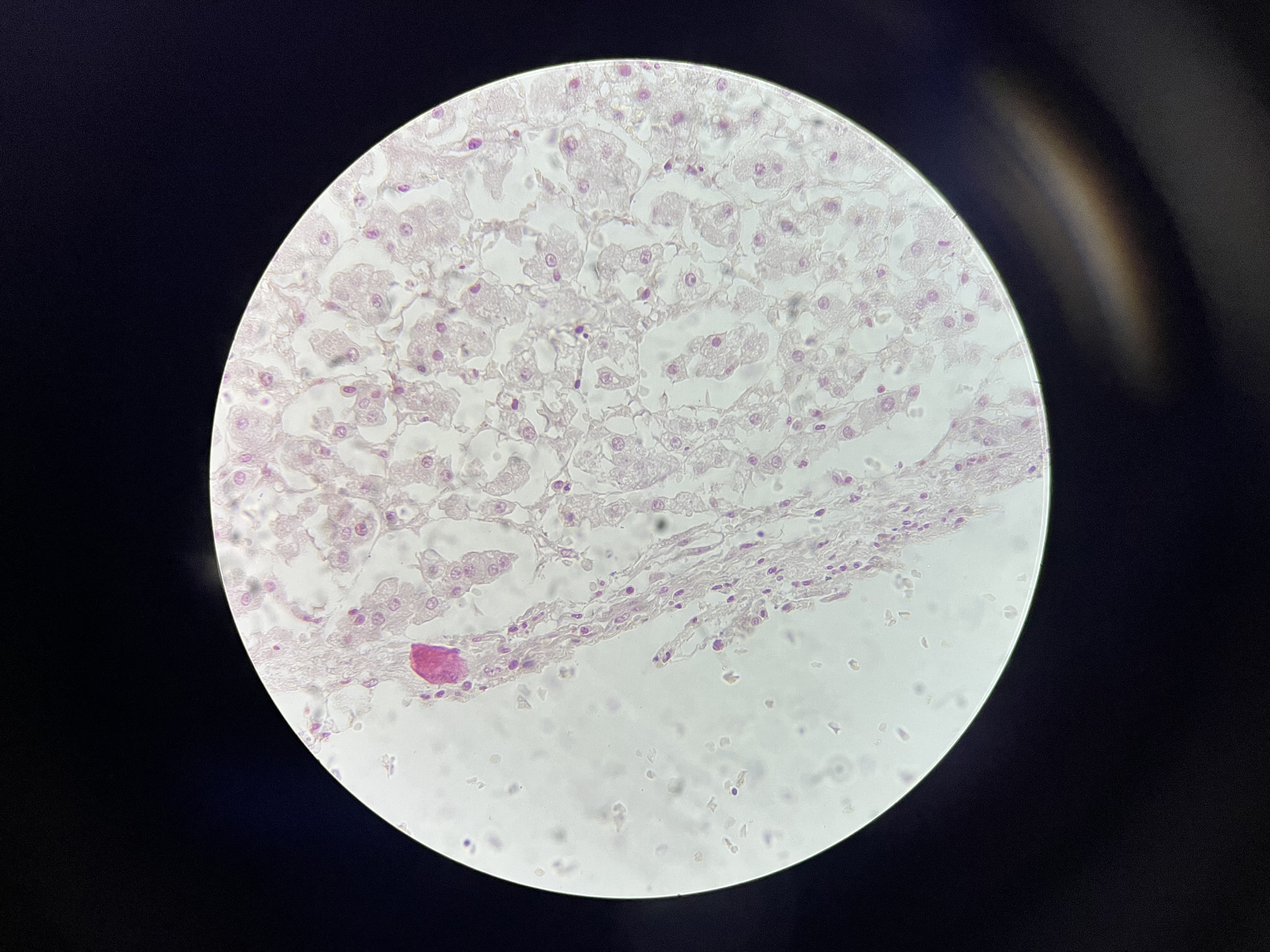 <p><span>Characterized by the presence of blood within the adrenal glands, often resulting in necrosis and infarction of adrenal tissue due to sudden vascular compromise.</span></p>