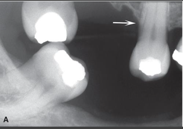 <p>Horizontal Bone Loss</p>