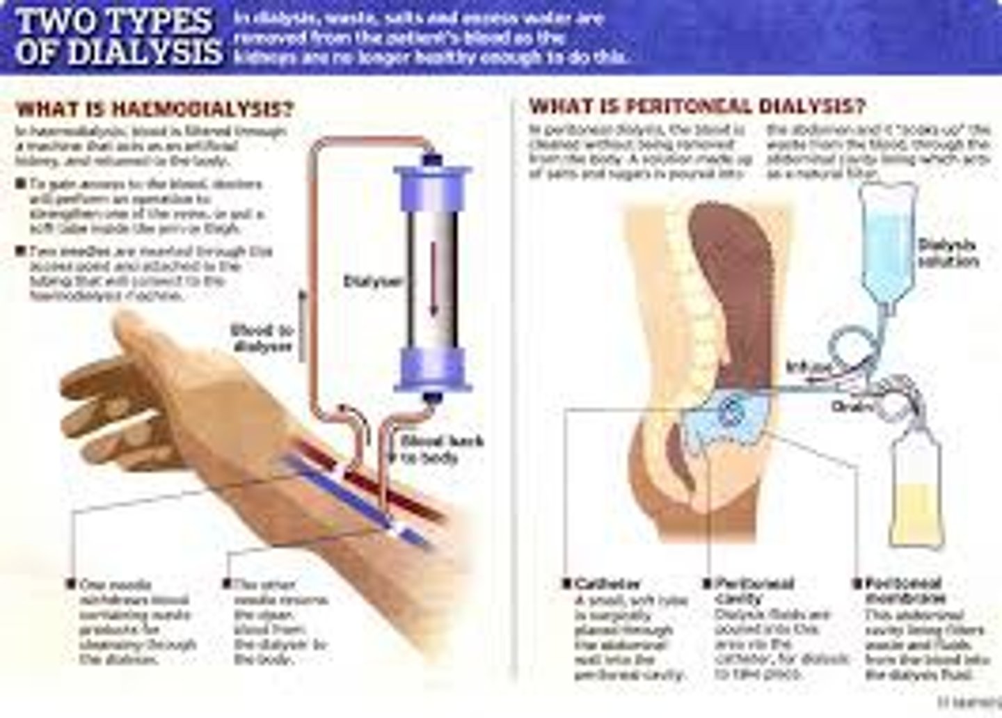 <p>a procedure to remove waste products from the blood of patients whose kidneys no longer function</p>