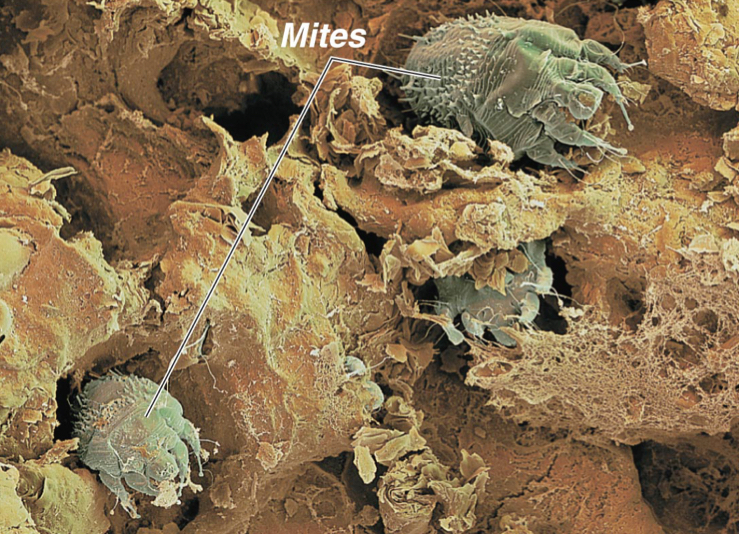 Scabies: (Parasitic infestations of the skin)