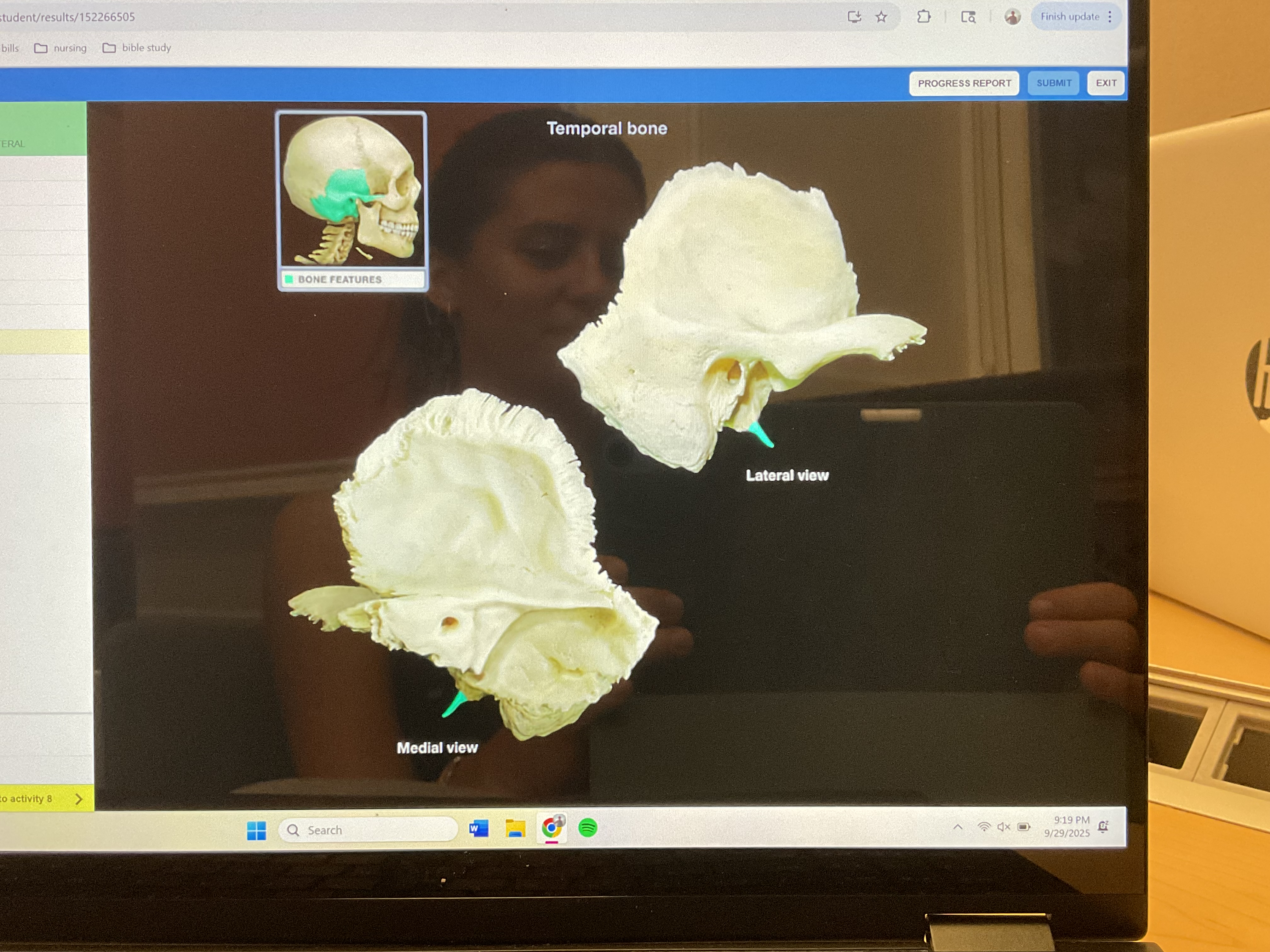 <p>Styloid process of temporal bone </p>