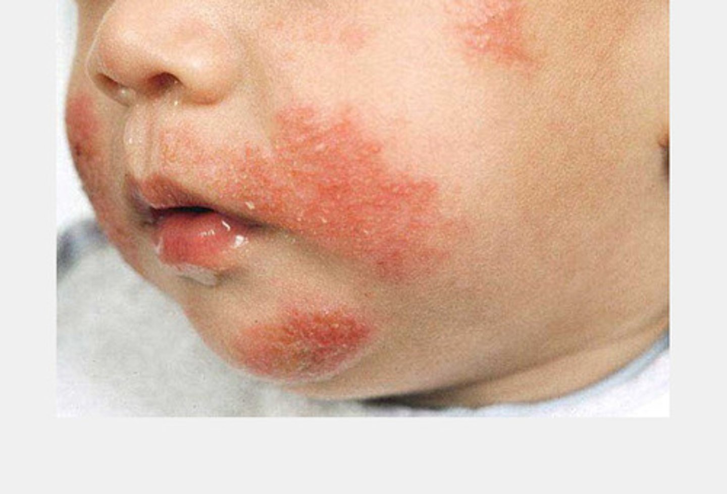<p>Non infections inflammatory skin disease characterized by redness blisters scabs and itching</p>