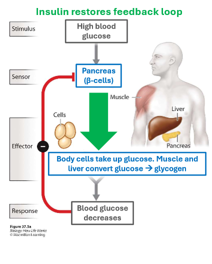 <p>exogenous insulin to replace the critical role of the beta cells in the body</p>
