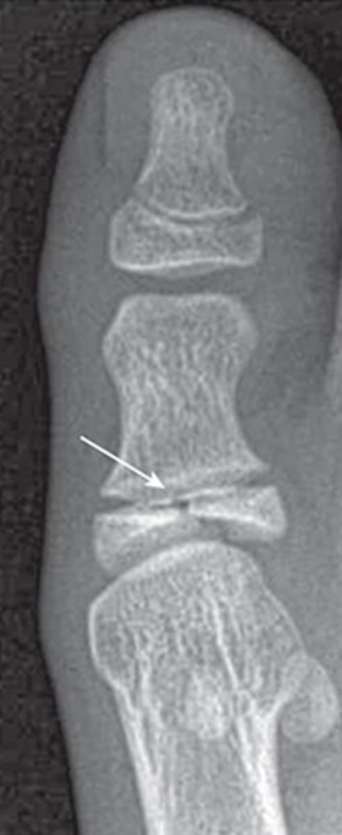 <p>What type of fracture is this?</p>