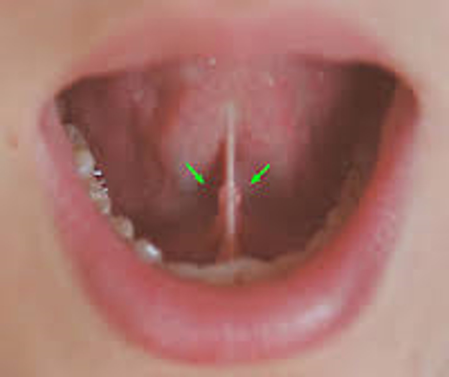 <p>A pair of papillae under the floor of the mouth extending from the first molar on either side of the lingual frenum. Each papillae contains an opening of the submandibular and sublingual salivary glands.</p>
