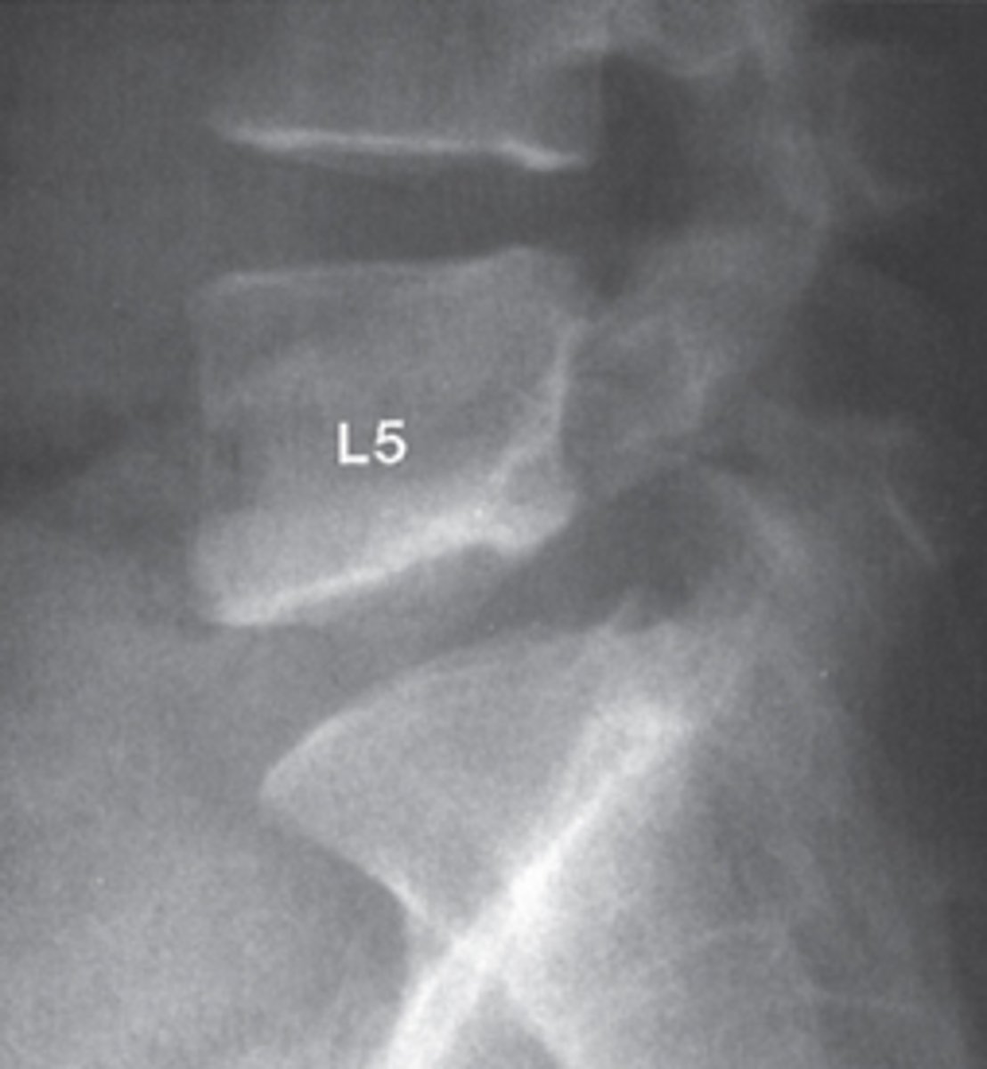 <p>What is the abnormality ?</p><p>The bones are too dense.</p><p>The bones are not dense enough (osteopenia).</p><p>There is a destructive bony lesion.</p><p>There is an abnormality of alignment(spondylolisthesis</p><p>There is a soft-tissue abnormality.</p>
