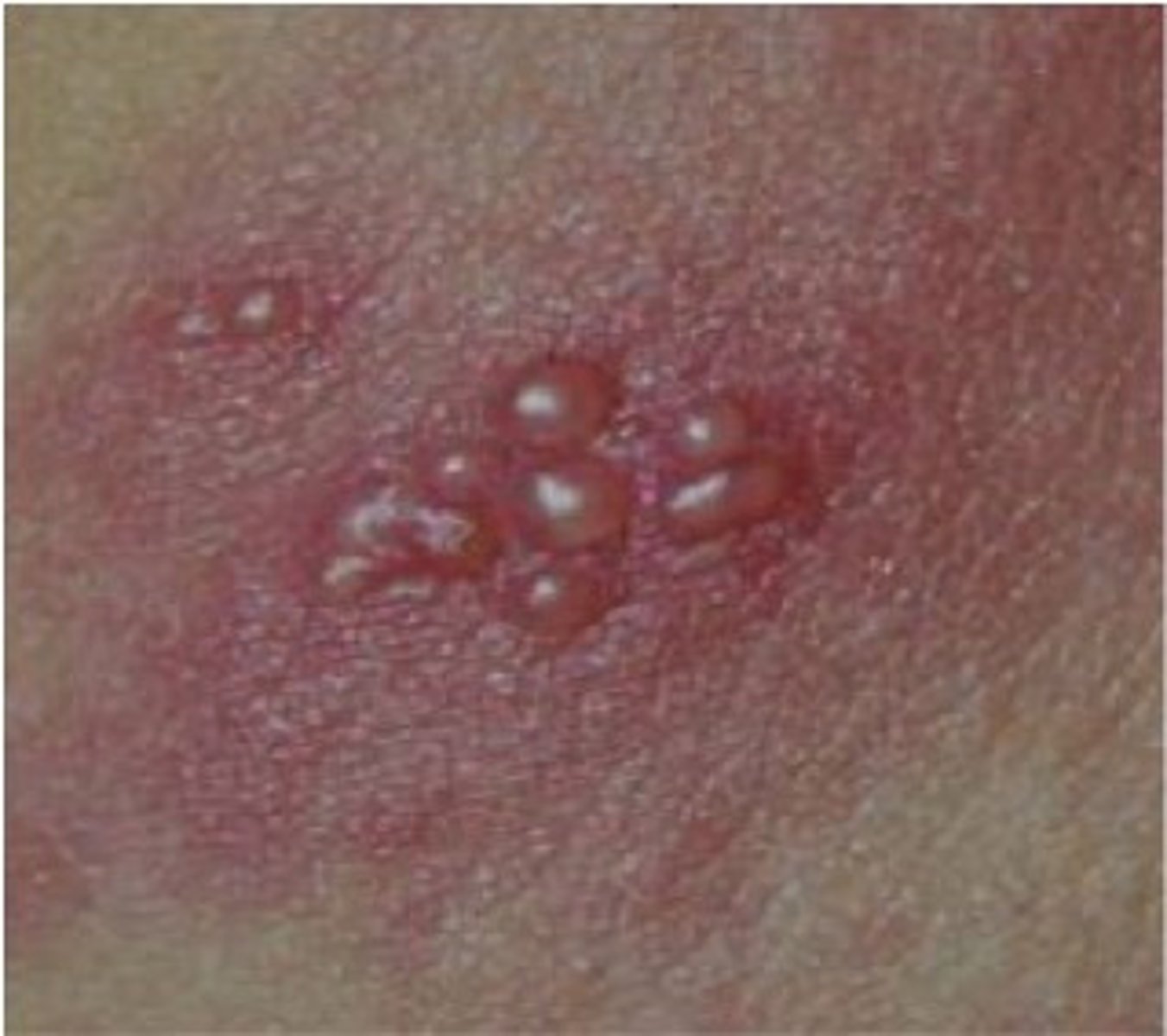 <p>small, fluid-filled blisters &lt; 10 mm in diameter. Are characteristic of herpes infections, acute allergic contact dermatitis, and some autoimmune blistering disorders</p>