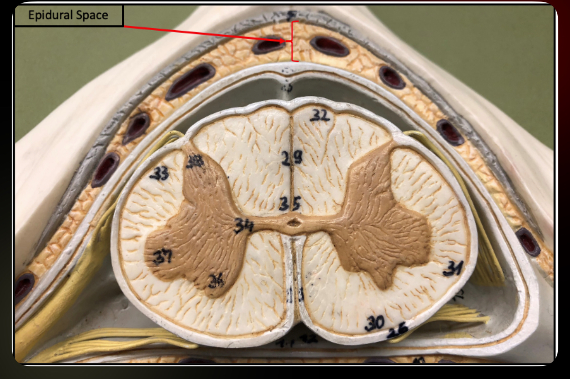 <p>Epidural Space</p>