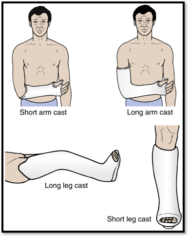 <p><span>•Casts</span></p><p><span>•Upper extremities</span></p><p><span>•</span><strong><u><span>Vertebral Injuries</span></u></strong><span>: Body Jacket Brace</span></p><p><span>•</span><strong><u><span>Lower extremity injurie:</span></u></strong><span> Robert Jones Dressing</span></p><p><span>&nbsp;</span>Hip <span>spica cast</span></p>