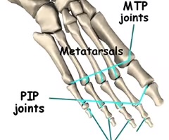 <p><span>metatarsophalangeal joint. the joint between the the tarsal bone and the proximal phalange of a given toe. </span><strong>MCP is for hand and MTP is for foot.</strong></p>