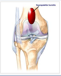 <p>Which tendons reinforce the <strong>lateral </strong>and <strong>medial </strong>sides of the <strong>suprapatellar </strong>bursa?</p>