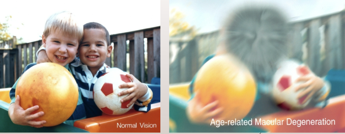 <p>affects retina and central vision- loss of central vision, loss of visual acuity, increased glare </p>