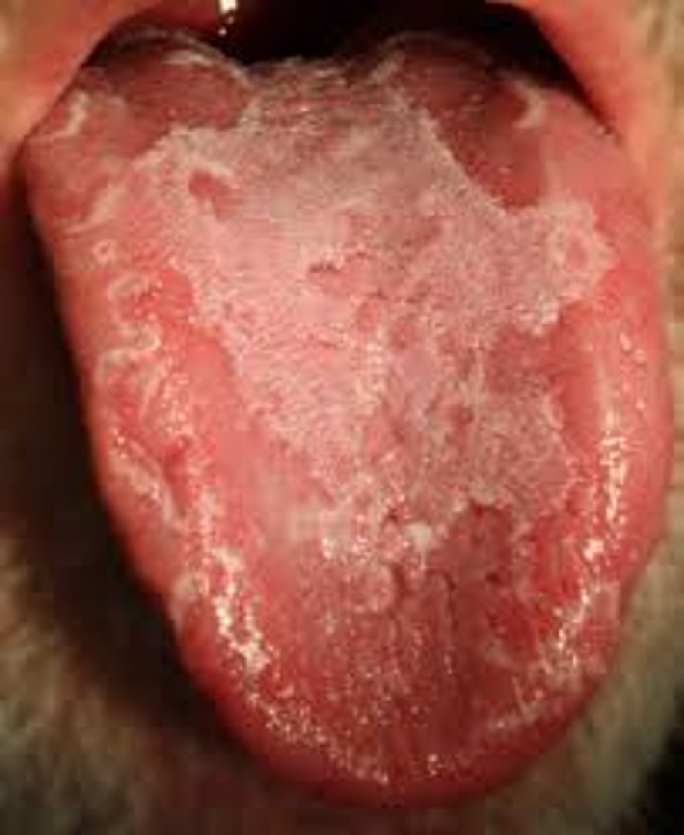 <p>sore, inflamed tongue</p>