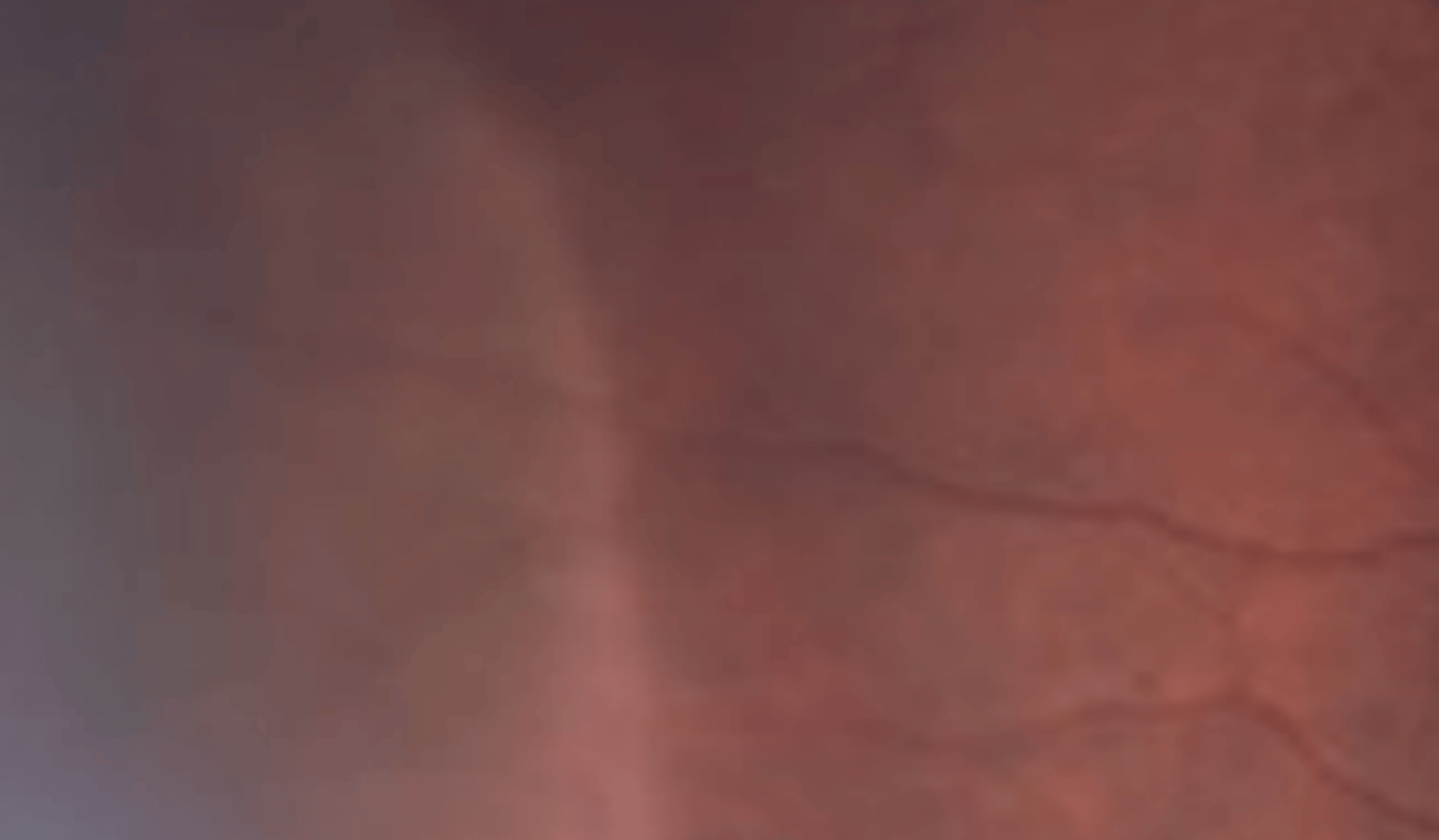 <p>white appearance of the peripheral retina visible without scleral depression. Is thought to be caused by an abnormal vitreo-retinal relationship resulting in disorganization of the NFL. Could also be caused by thickening ellipsoid zone. Is more common in dark fundi and myopes. Is usually temporal and bilateral.</p>