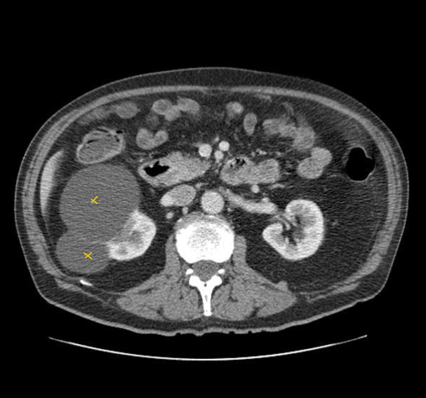 <p>pocket of fluid on kidneys, single or multiple, can be unilateral or bilateral<br>– no signs or symptoms but maybe flank pain/hematuria</p>
