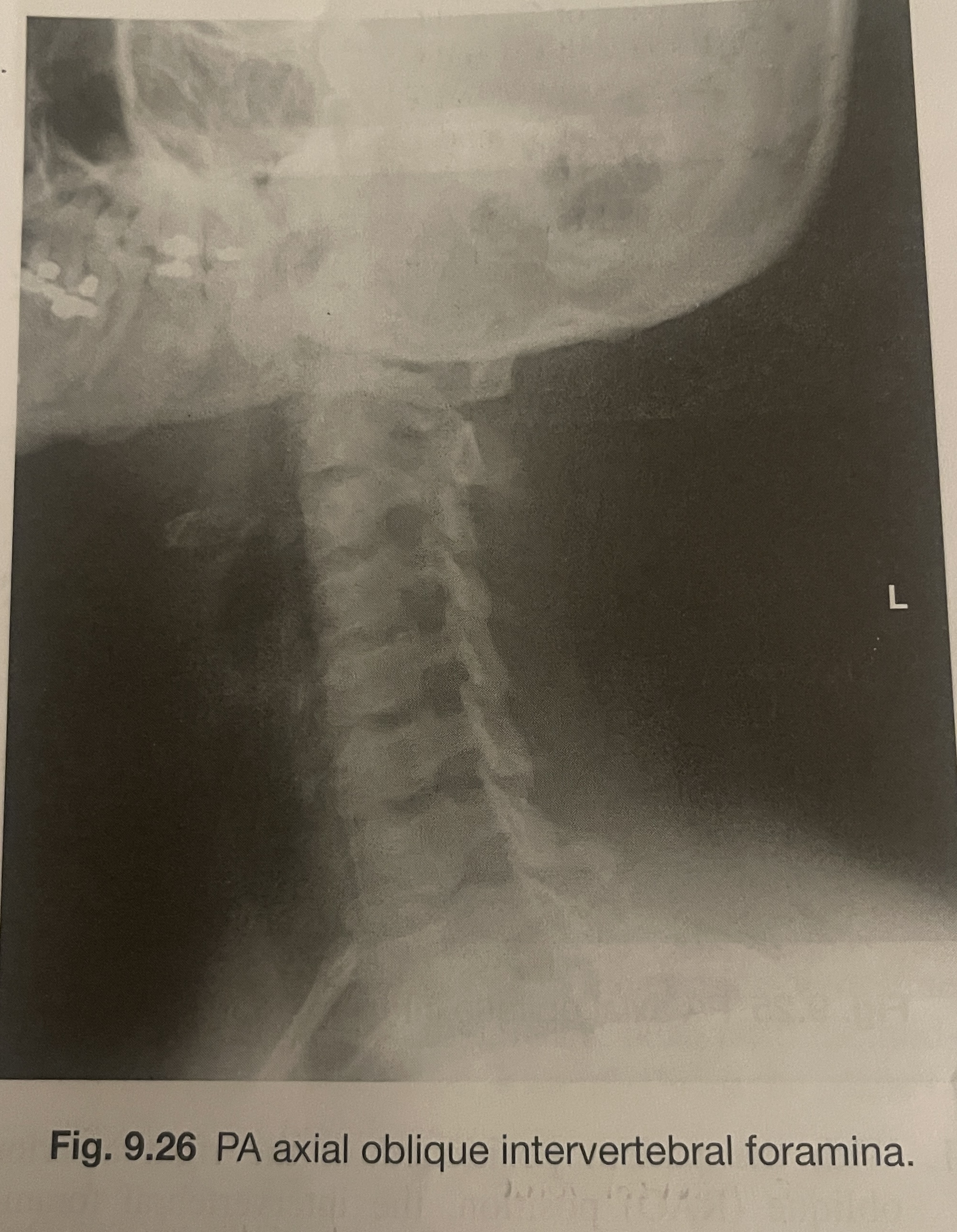 <p>Are the open intervertebral foramina demonstrated in this image closer or farther from the IR?</p>