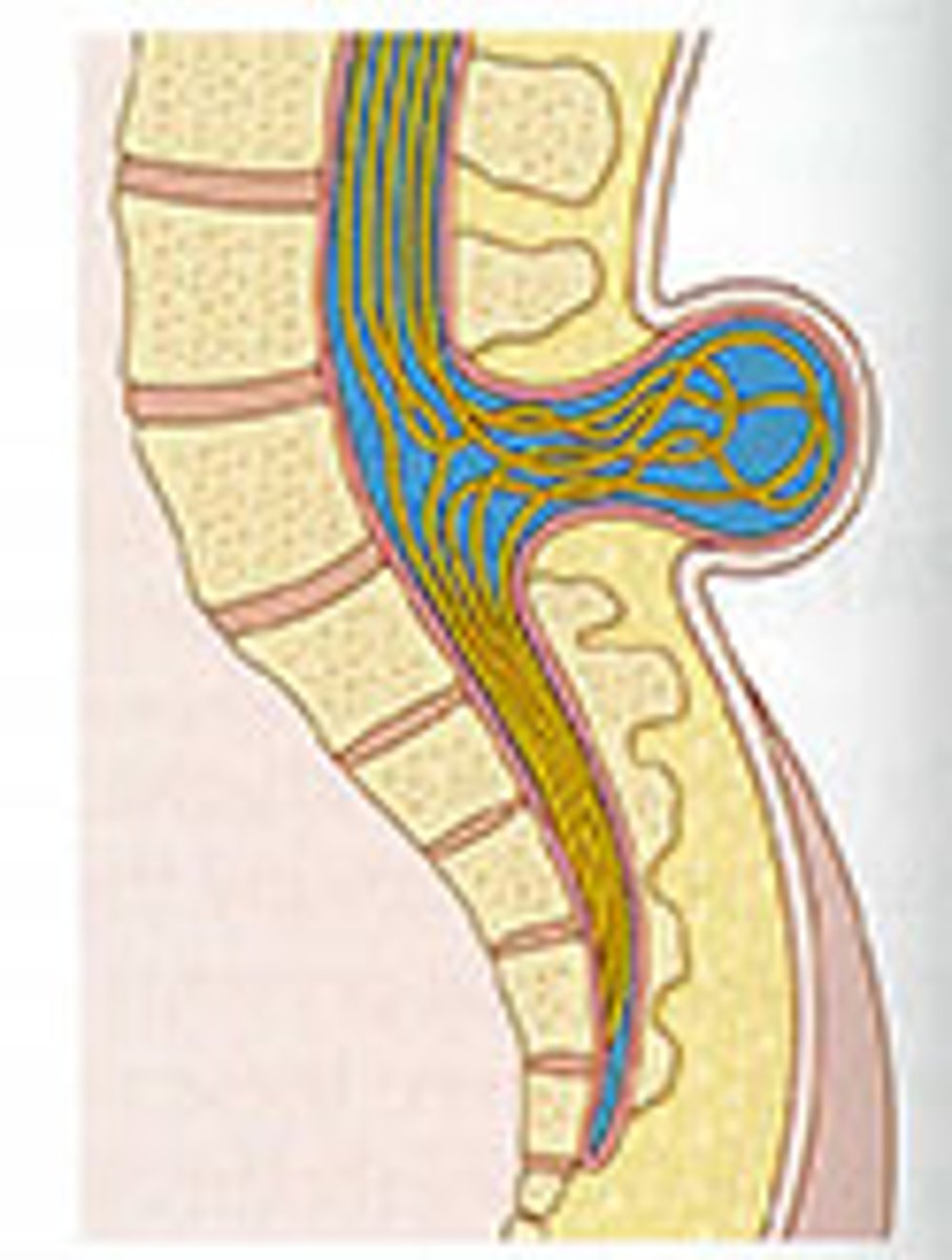 <p>nerves protrude with meningeal herniation</p><p>- can cause nerve impairment</p><p>- most severe</p>