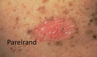 <p>Hoe heet dit klinisch beeld? </p>