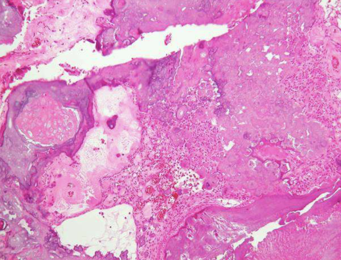 <ol><li><p>mature tubular dentin with structures that contained enamel before decalcification</p></li><li><p>20% show ghost cells</p></li><li><p>thin layer of cementum around mass</p></li></ol><p></p>