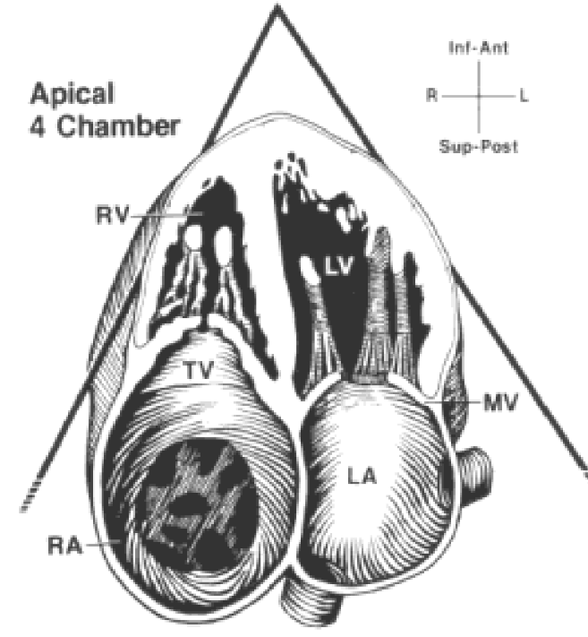 <ul><li><p>Thickened, echogenic leaflets with restricted movement</p></li><li><p>Diastolic doming</p></li><li><p>Decreased orifice size</p></li><li><p>Enlarged RA</p></li><li><p>Dilated IVC due to back up of blood</p></li></ul>