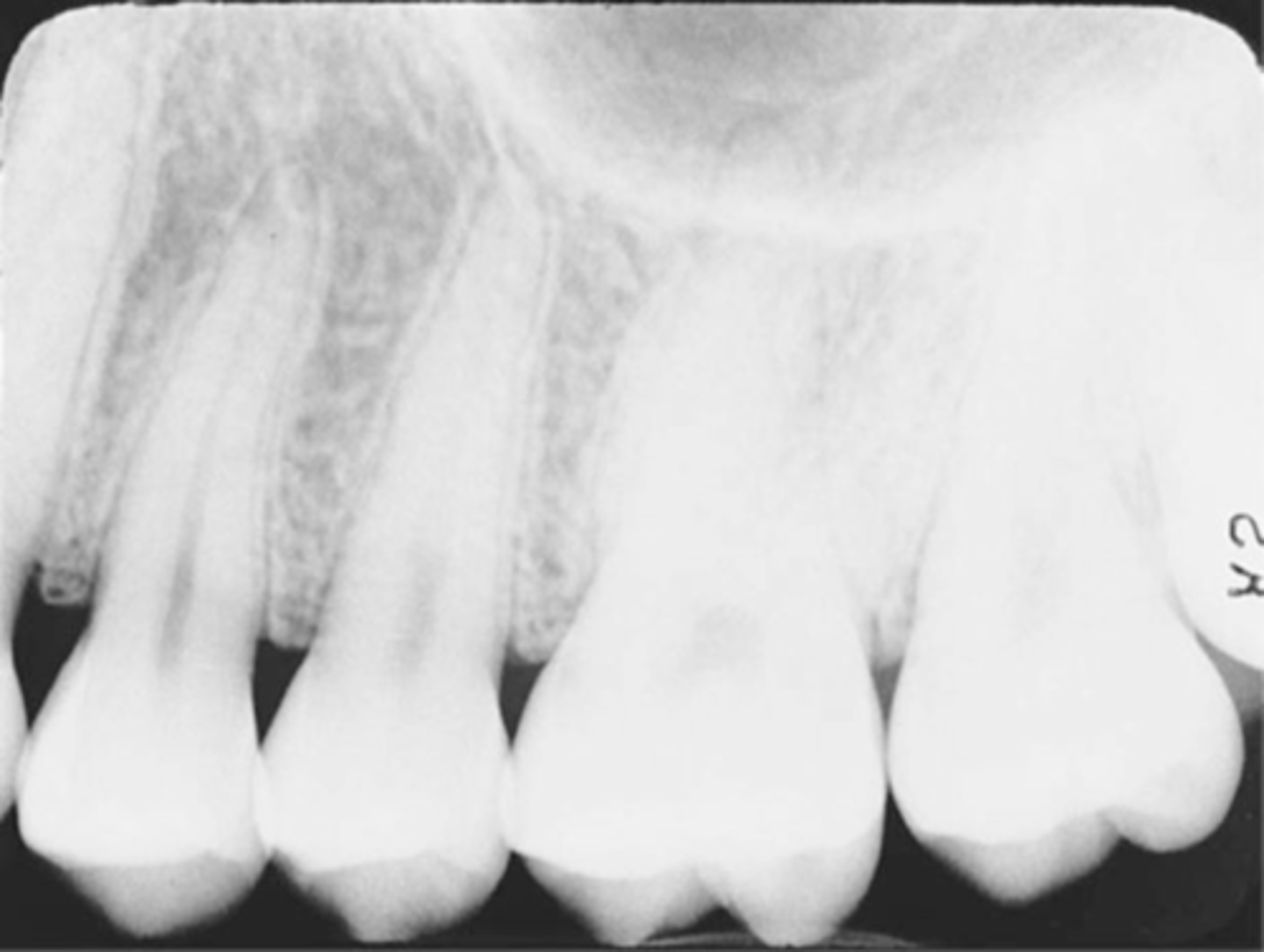 <p>On a dental image, the area where the contact area of one tooth is superimposed over the contact area of an adjacent tooth</p>