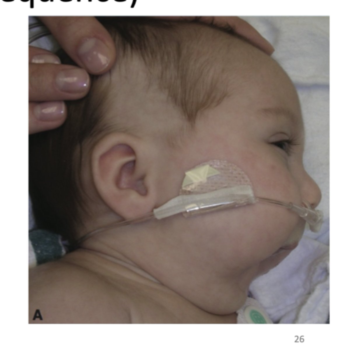 <p>What are some clinical manifestations of the Pierre Robin sequence? </p>