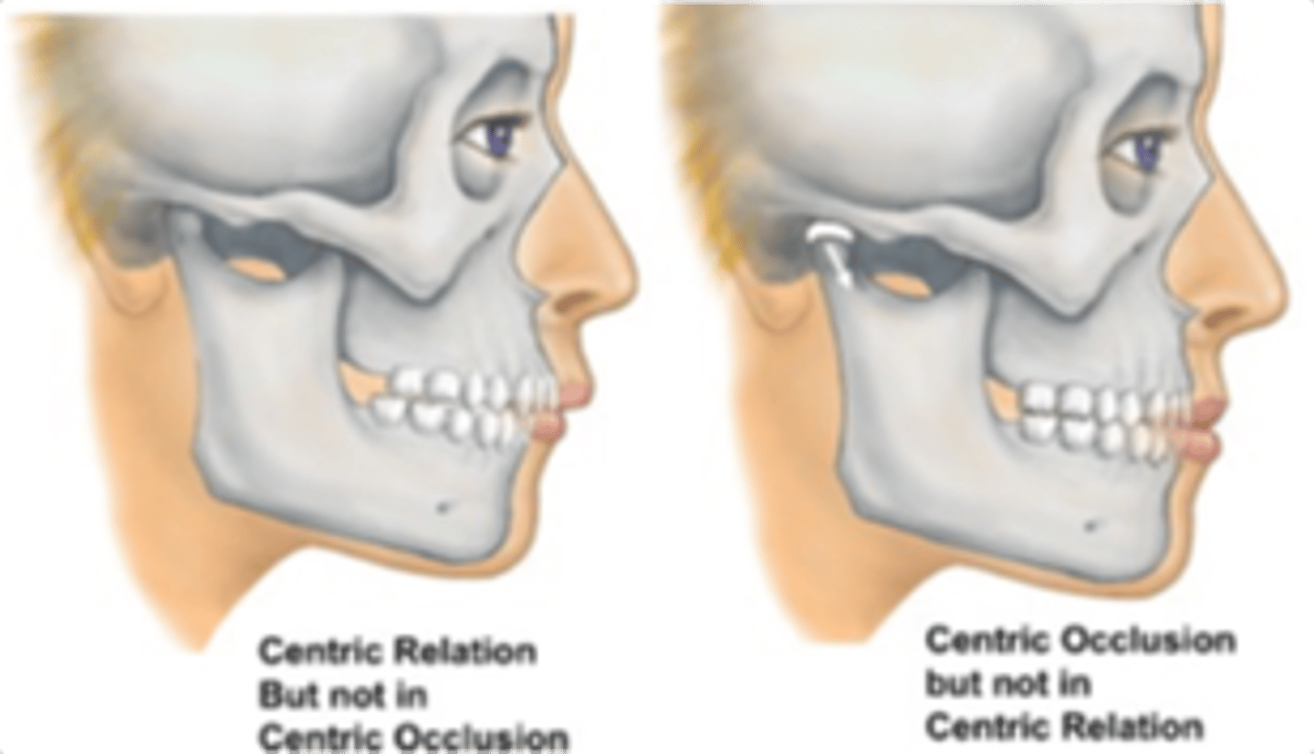 <p>tooth guided position where it depends on the initial tooth contact when the mandible closes</p>