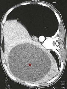 <p>8.4 Side A (PBD9: 396; BP9: 313)<br></p>
<p><br></p>
<p>Questions<br></p>
<p>A 26-year-old man from the Caucasus Mountains has a 2-year history of right upper quadrant pain. CT shows a hepatic cyst.<br></p>
<p><br></p>
<p>1. What parasitic infection does he likely have?<br></p>
<p>2. What is the definitive host and the usual intermediate host?<br></p>
<p>3. What is the life cycle of this organism?<br></p>