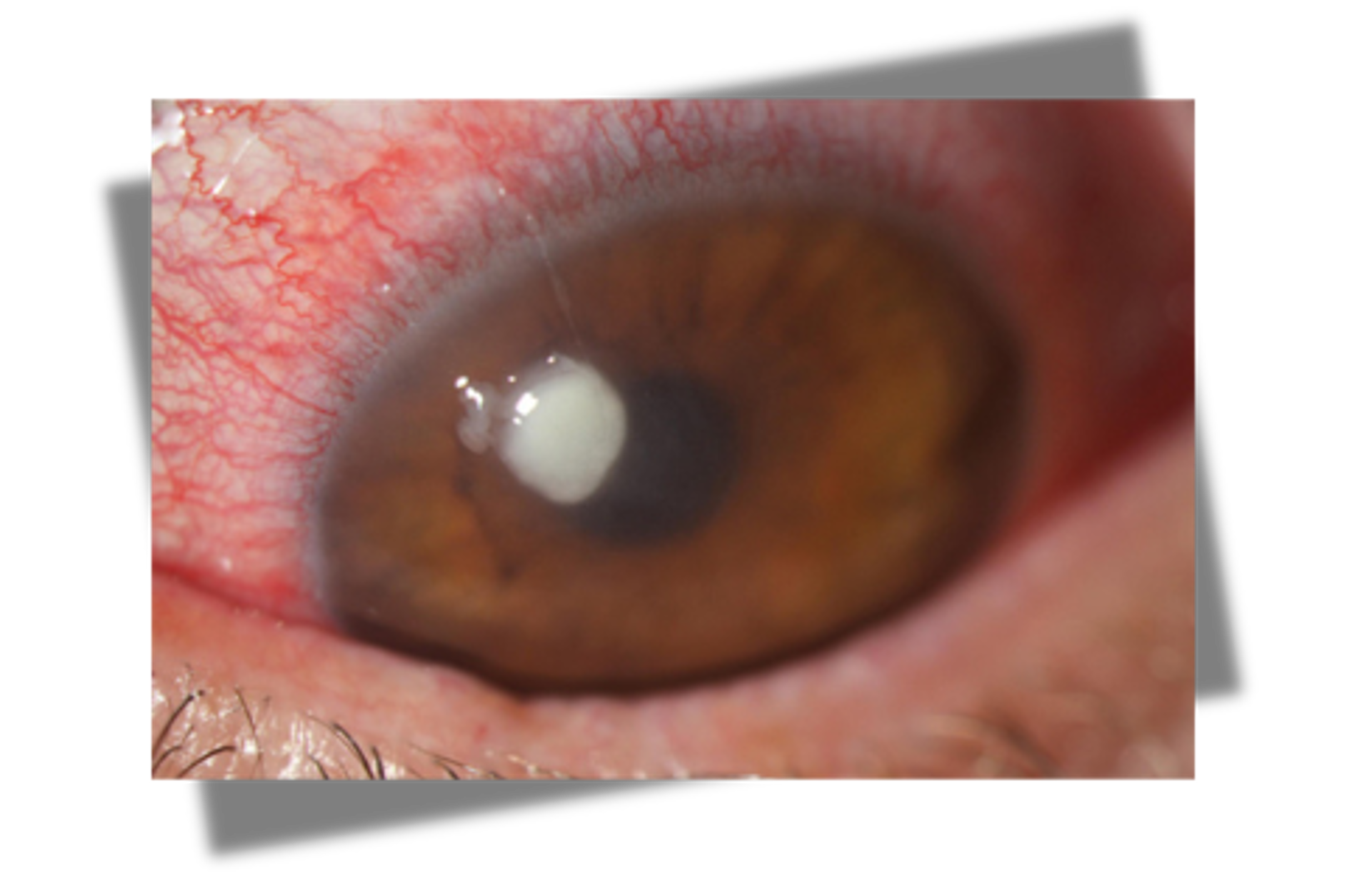 <p>redness, painful, corneal opacity </p>