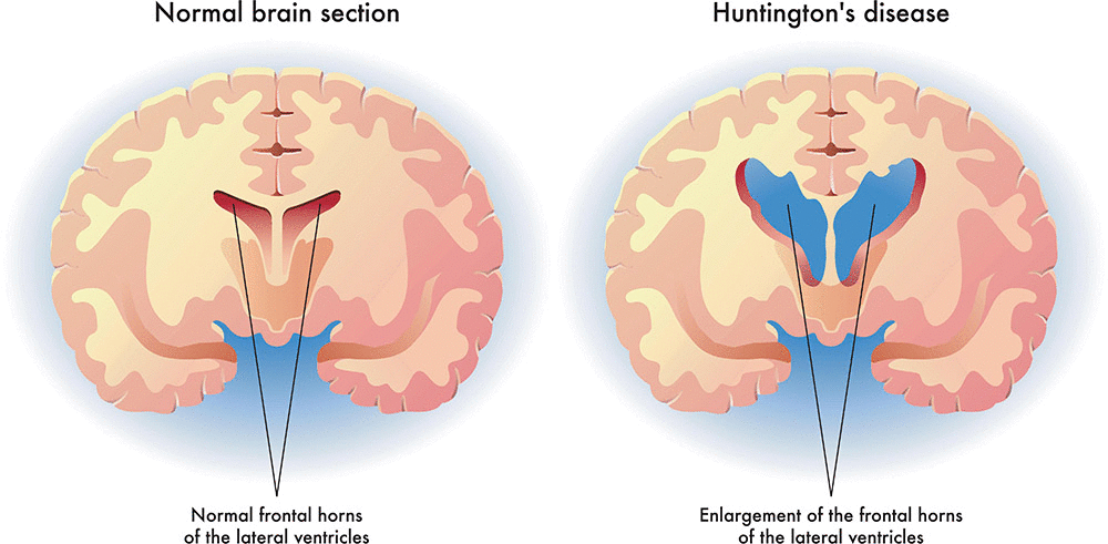 <p>Gradual shrinkage of the <strong>striatum</strong>, with a particular focus on the <strong>caudate nucleus</strong>.</p>