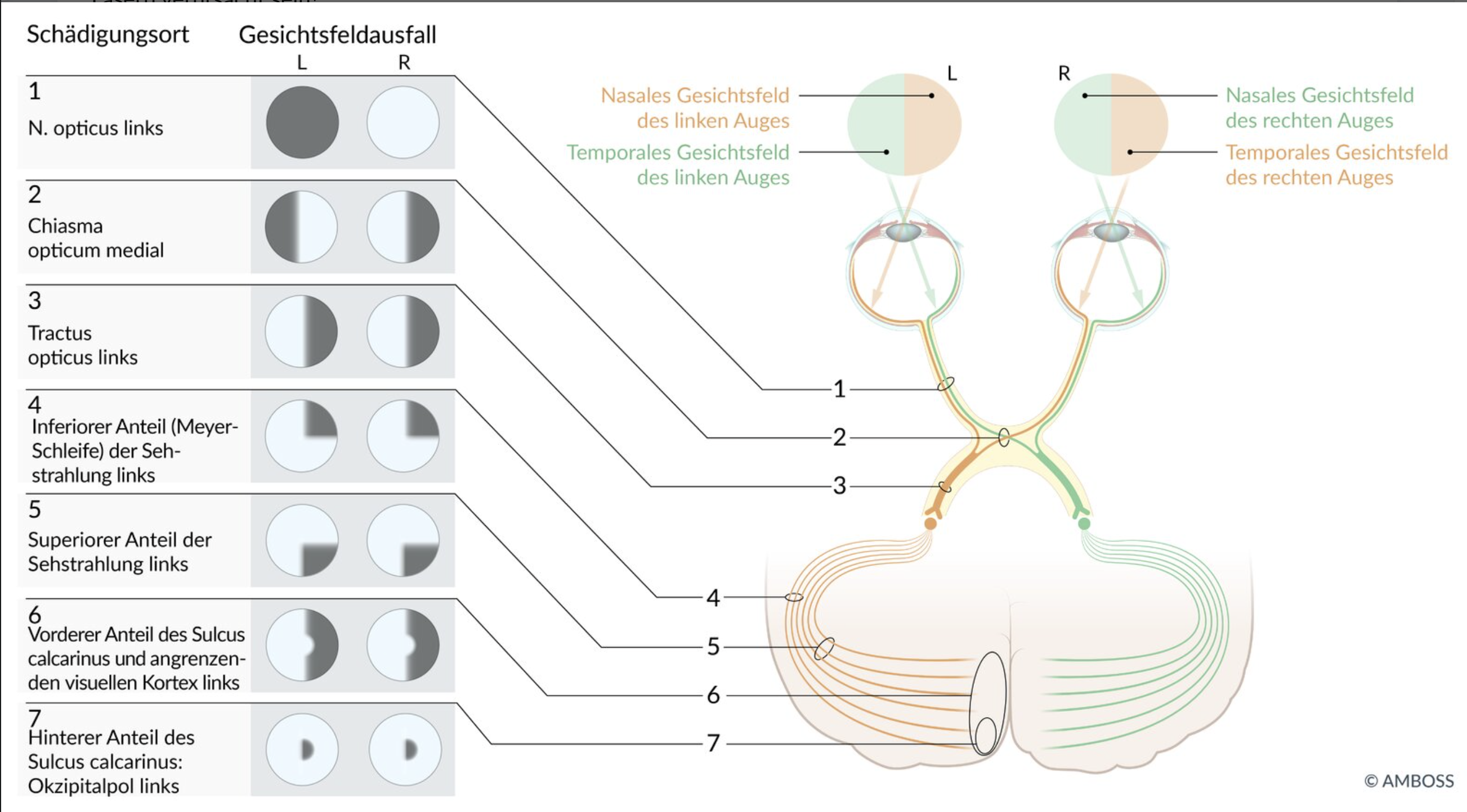 <p>B. Loss of the temporal visual fields in both eyes</p>