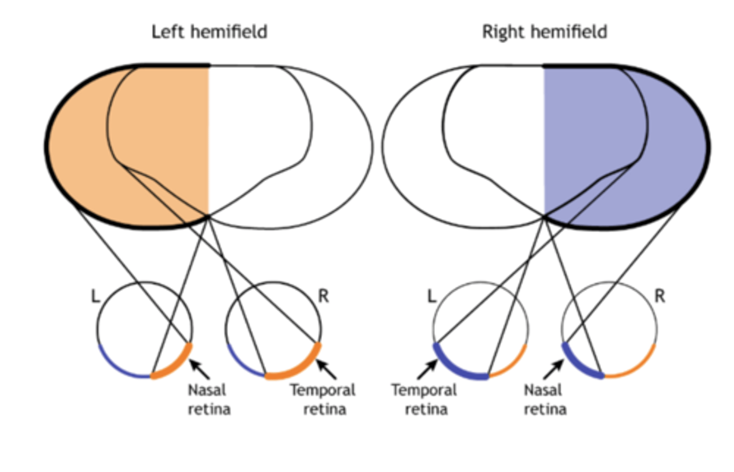 <p>Temporal retina - does cross the optic chasm</p>