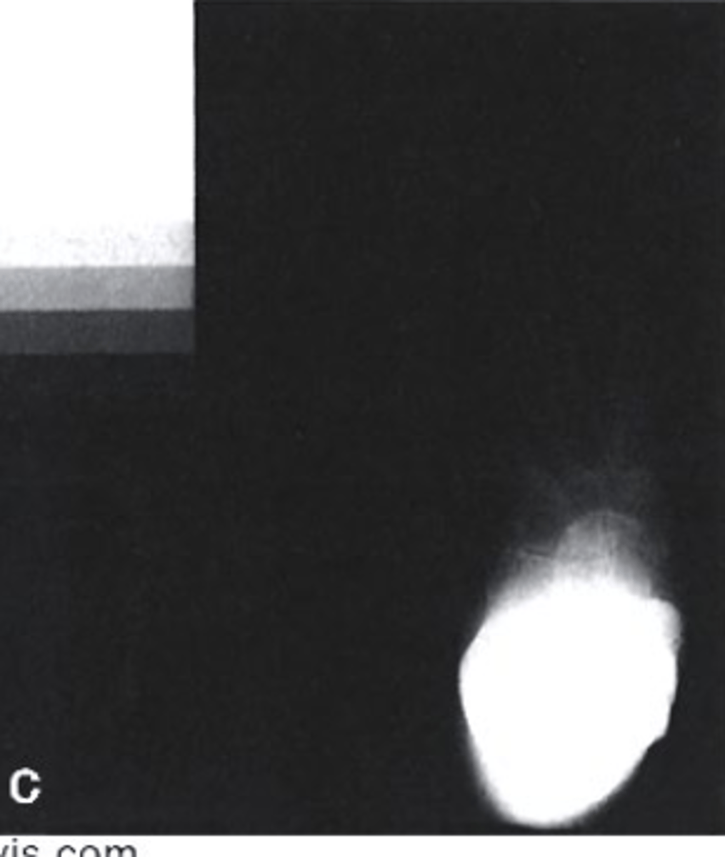 <p>Which of the following would be used to describe this radiograph?</p><p>a. Underexposed</p><p>b. Correctly Exposed</p><p>c. Overexposed</p>