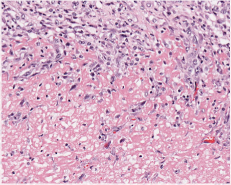 <p>enzymatic digestion </p><p>loss of cell borders </p><p>neutrophil rich inflammation (bacterial) </p>
