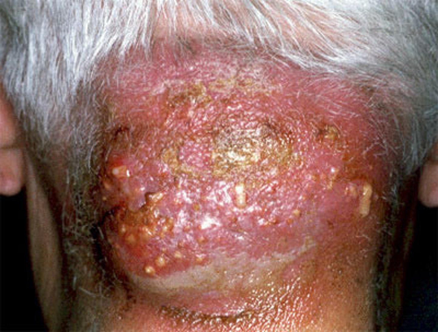 <p>1. nape of neck</p><p>2. head</p><p>3. any hair bearing areas</p>