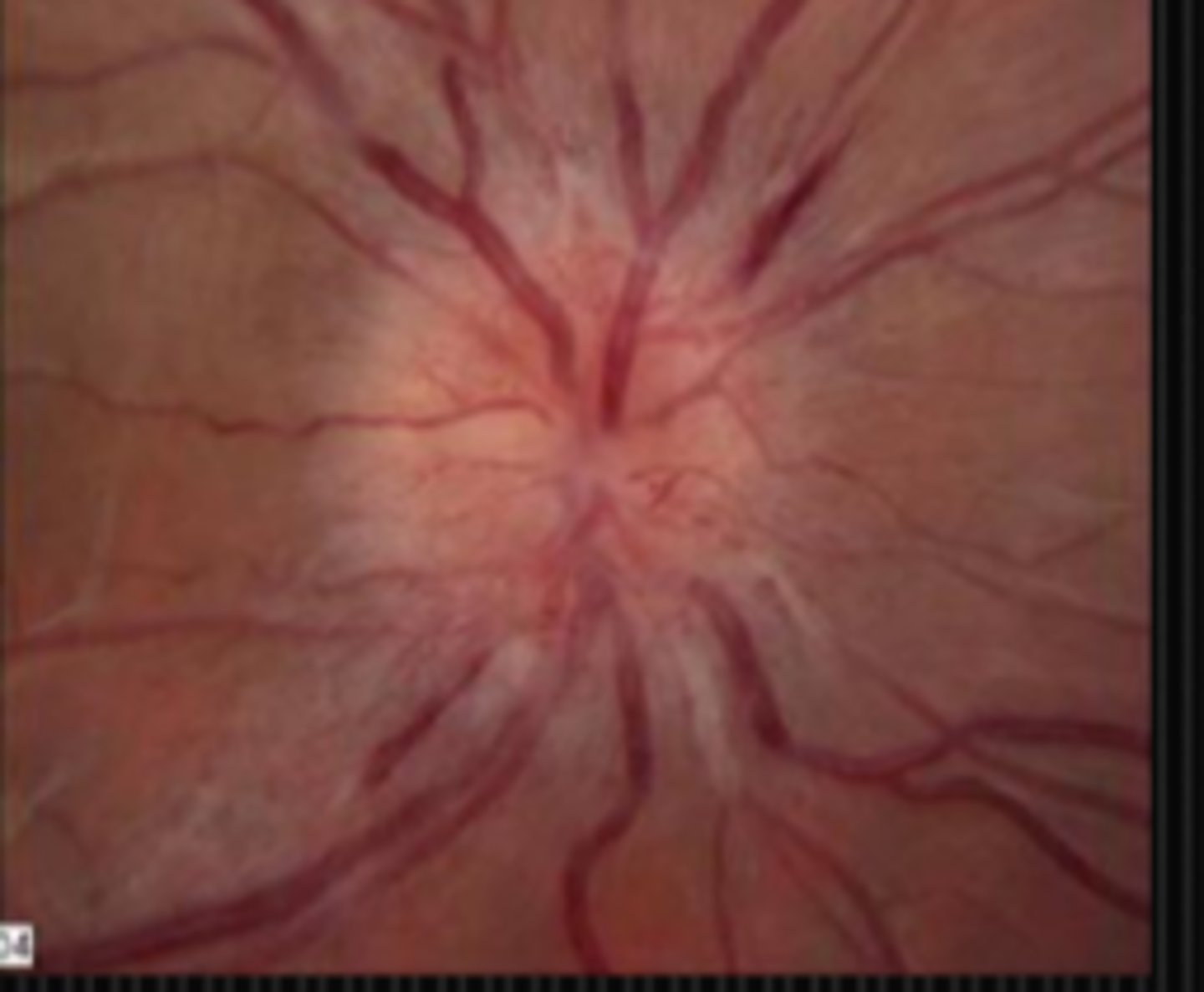 <p>teenage female = collagen vasc disease like lupus</p><p>middle aged female = ischemic optic neuropathy</p><p>elderly female = ischemic optic neuropathy, GCA</p>