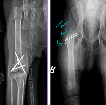 <ul><li><p><span style="background-color: transparent;"><strong><span>Why</span></strong><span>: </span><u><span>physeal </span></u><span>fractures </span></span></p><ul><li><p><span style="background-color: transparent;"><span>femur, tibia</span></span></p></li></ul></li><li><p><span style="background-color: transparent;"><strong><span>What:</span></strong><span> Small smooth IM pins</span></span></p></li><li><p><span style="background-color: transparent;"><strong><span>How: </span></strong><span>inserted </span><u><span>laterally, cross physis and eachother</span></u></span></p></li></ul><p></p>