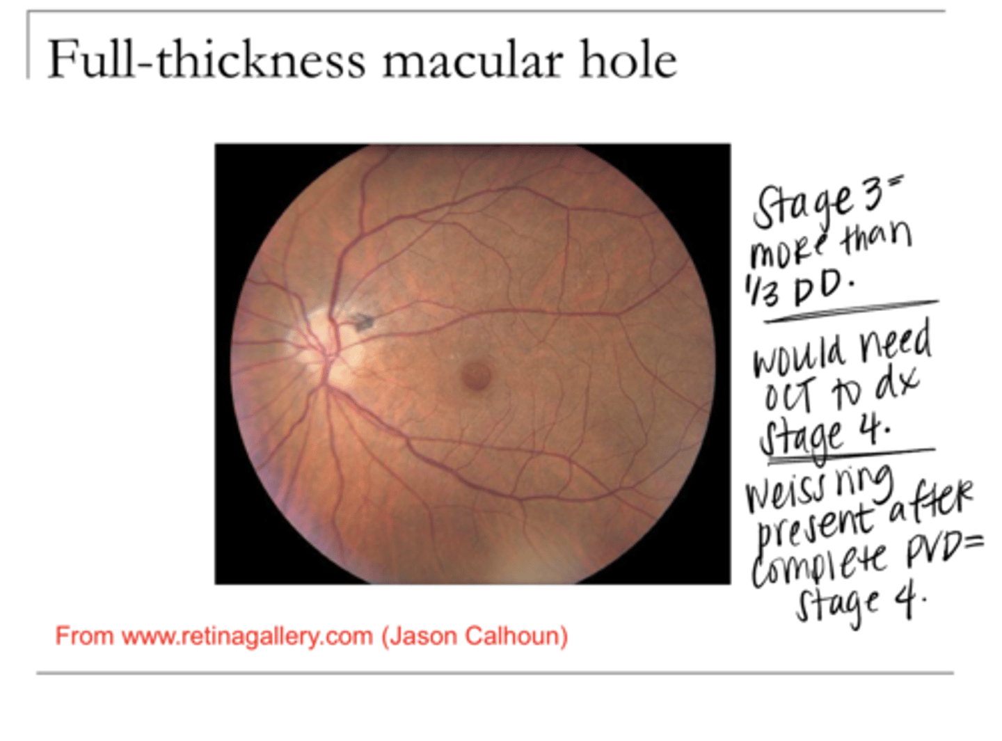 <p>Describe Stage 3 Macular Hole</p>