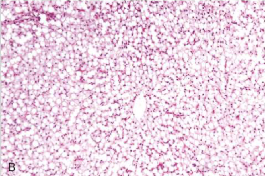 <p>What is this showing of a histologic slide of the liver?</p>