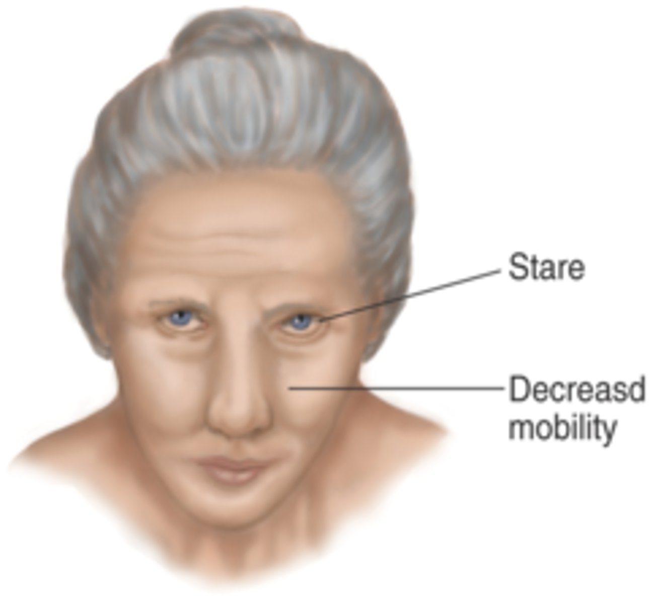 <p>a negative symptom of schizophrenia characterized by a lack of emotional expression (e.g., no facial expression, no eye contact, monotone voice, no body language, apathy)</p>