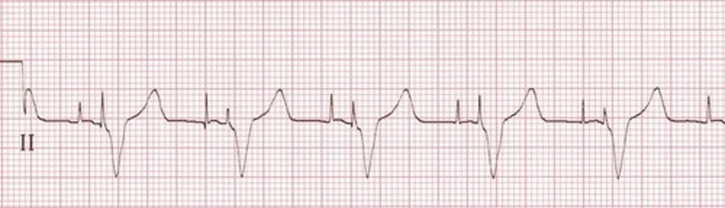 <p>Pacemaker Rhythm with *pacing spikes"</p>