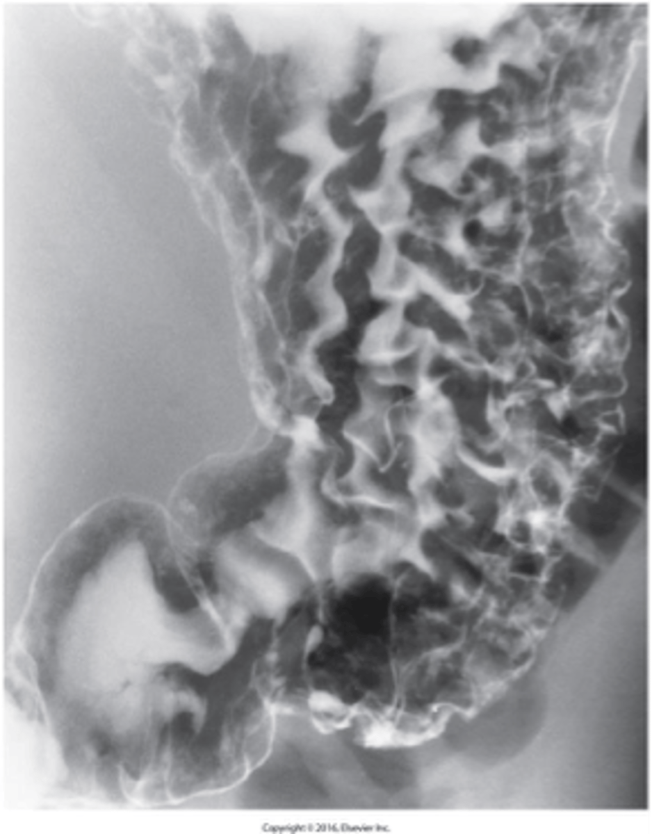 <p><strong>What does gastritis appear as?</strong></p>