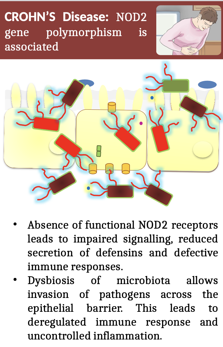 <ul><li><p>Absence of functional NOD2 receptors<br>leads to impaired signalling, reduced<br>secretion of defensins and defective<br>immune responses.</p></li><li><p>Dysbiosis of microbiota allows invasion of pathogens across the<br>epithelial barrier. This leads to deregulated immune response and<br>uncontrolled inflammation</p></li></ul><p></p>